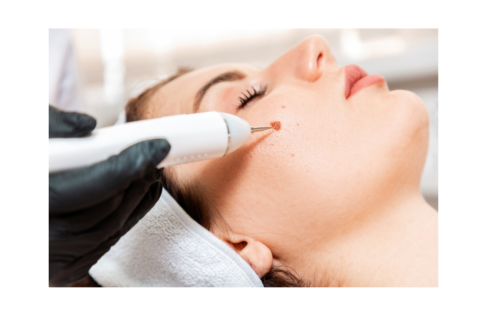 Skin Tag Removal - Treatment (Liquid Nitrogen)
