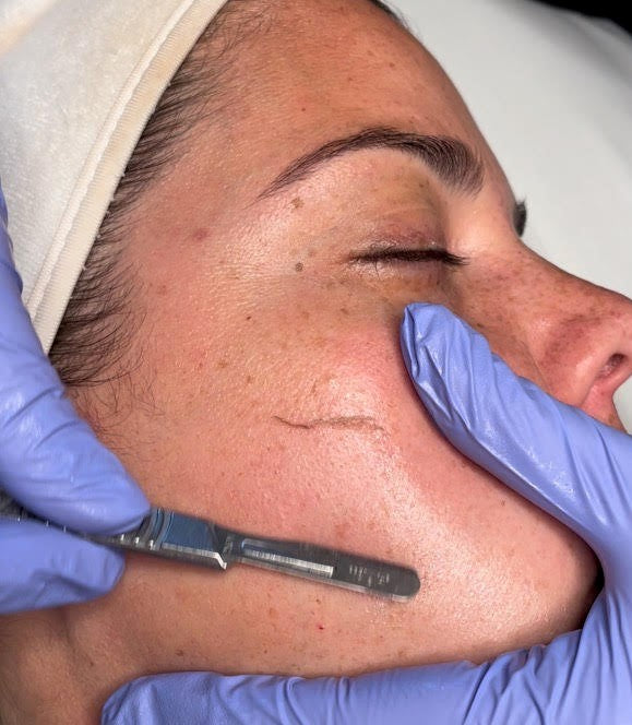 Full Face Dermaplaning