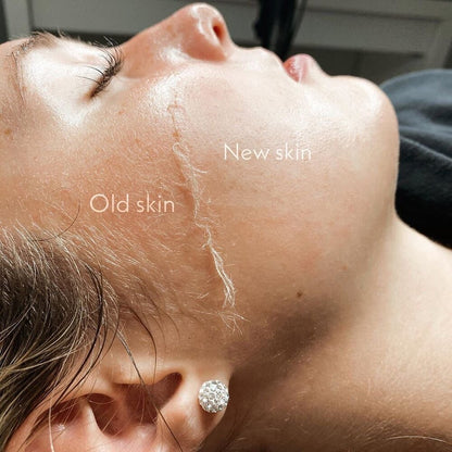 Full Face Dermaplaning