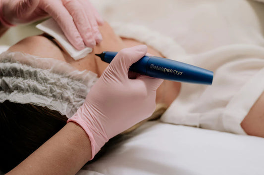 Skin Tag Removal - Treatment (Liquid Nitrogen)