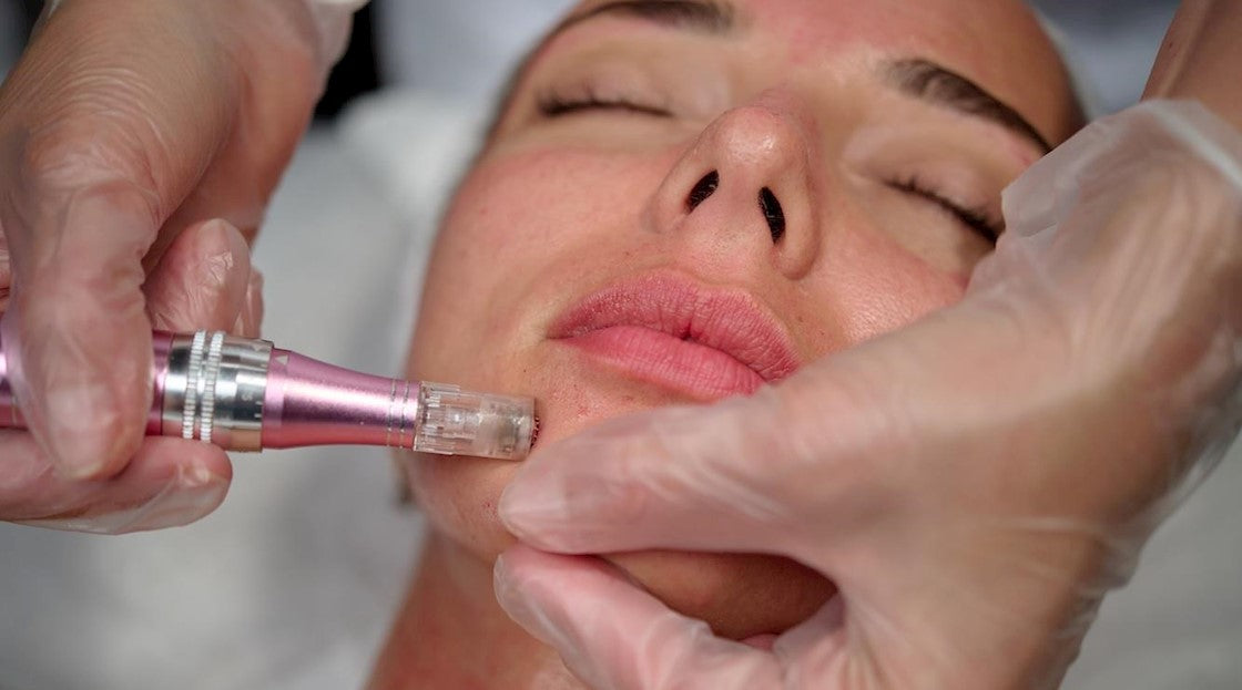 Micro Needling or Nano Needling Treatment